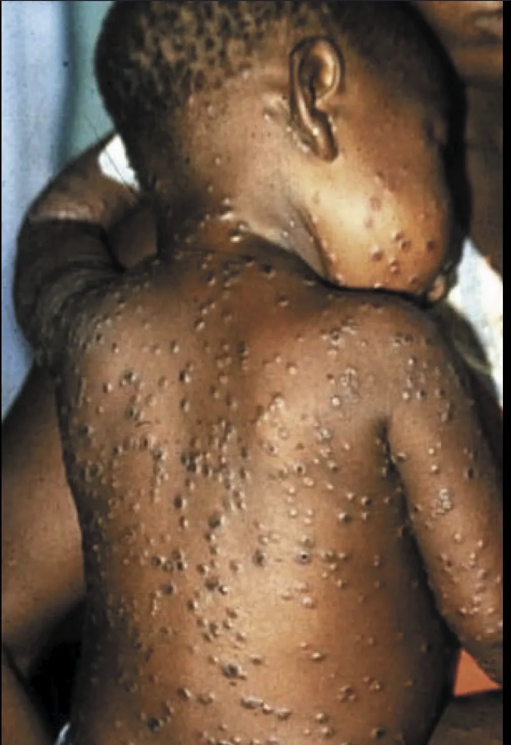 Mpox Biological Standard Pandemic Preparedness AI - Infiuss Health Mpox Biological Standard Pandemic Preparedness AI - Infiuss Health